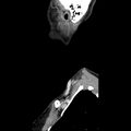Normal CT of the neck (Radiopaedia 14575-14500 Sagittal C+ 7).jpg