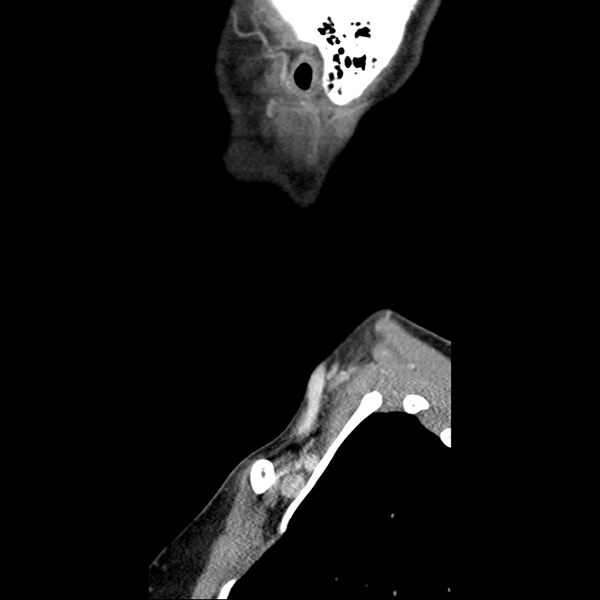 File:Normal CT of the neck (Radiopaedia 14575-14500 Sagittal C+ 7).jpg