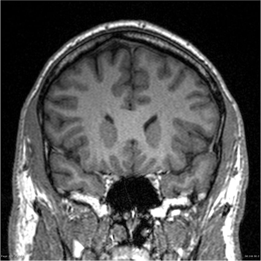 Normal brain MRI (non-focal epilepsy protocol) (Radiopaedia 38571-40700 Coronal T1 72).jpg