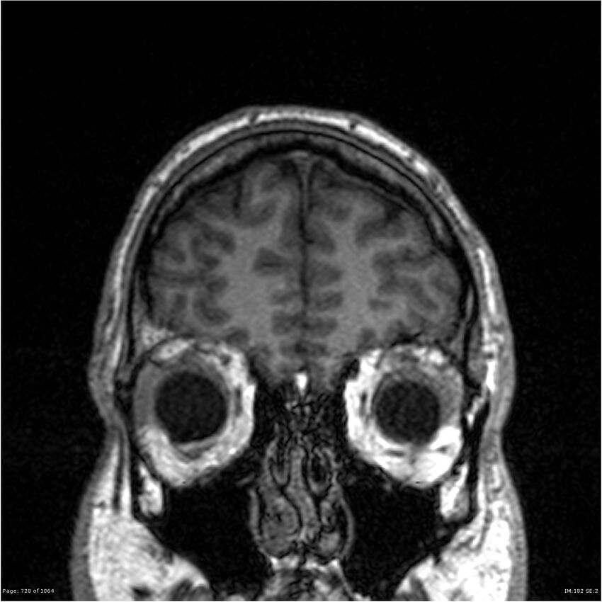 Normal brain MRI (non-focal epilepsy protocol) (Radiopaedia 38571-40700 Coronal T1 90).jpg
