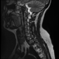 Normal cervical and thoracic spine MRI (Radiopaedia 35630-37156 Sagittal T2 3).png