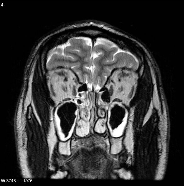 File:Normal coronal brain (Radiopaedia 6676-7910 Coronal T2 4).jpg