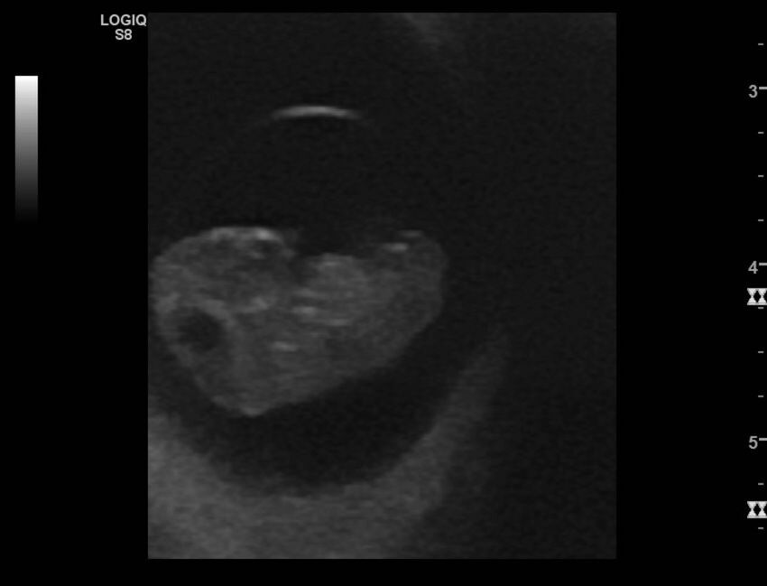 Normal early pregnancy - 8w0d (Radiopaedia 44715-48492 Longitudinal 29).jpg