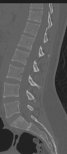 File:Normal lumbosacral CT (Radiopaedia 37923-39867 Sagittal bone window 46).png