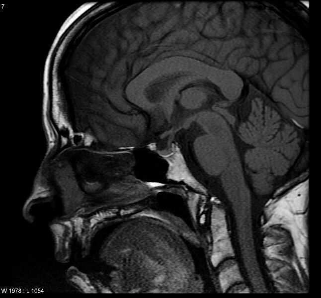 File:Normal pituitary (Radiopaedia 7800-8624 Sagittal T1 1).jpg