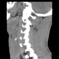 Normal trauma cervical spine (Radiopaedia 41017-43760 B 21).png