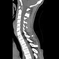 Normal trauma spine imaging (age 16) (Radiopaedia 45335-49358 C 17).jpg