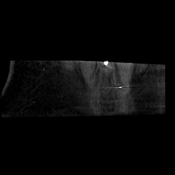 File:Oblique sublaminar lumbar puncture (Radiopaedia 90103-107350 Coronal non-contrast 12).jpeg