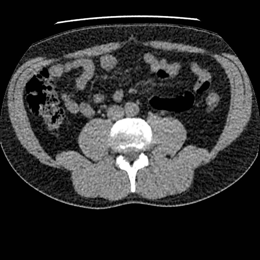 Obstructing ureteric calculus and ureteric anatomy (Radiopaedia 62730-71042 Axial non-contrast 76).jpg