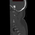 Occipital condyle fracture (Radiopaedia 18366-18208 Sagittal bone window 3).jpg