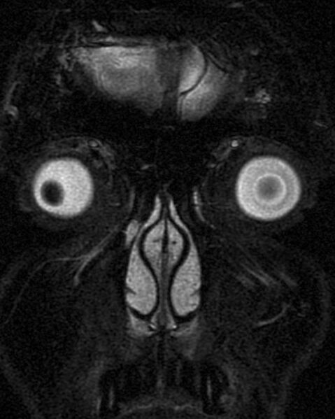 File:Oculomotor nerve palsy (Radiopaedia 35833).jpg