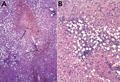 Liver biopsy sample with (fatal) human monocytic ehrlichiosis