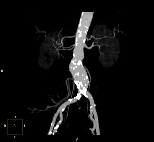File:Abdominal aortic aneurysm (Radiopaedia 23703-23856 MIP 1).jpg