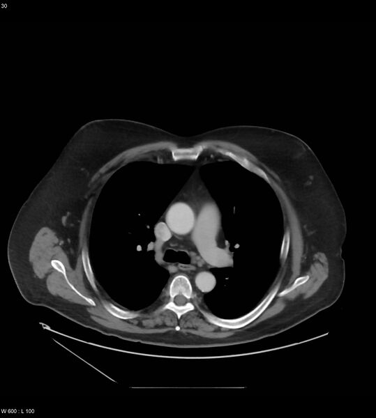File:Abdominal aortic aneurysm with intramural hematoma then rupture (Radiopaedia 50278-55631 Axial C+ arterial phase 21).jpg