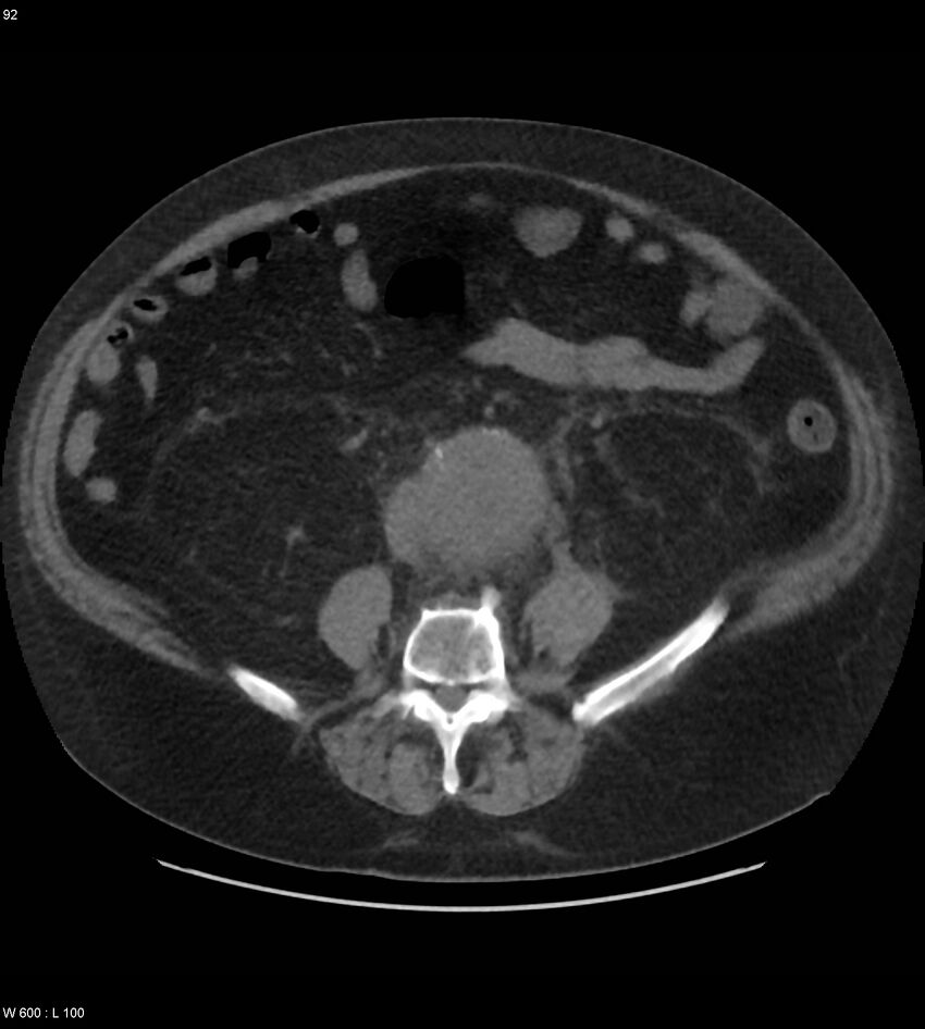 Abdominal aortic aneurysm with intramural hematoma then rupture (Radiopaedia 50278-55631 Axial non-contrast 88).jpg
