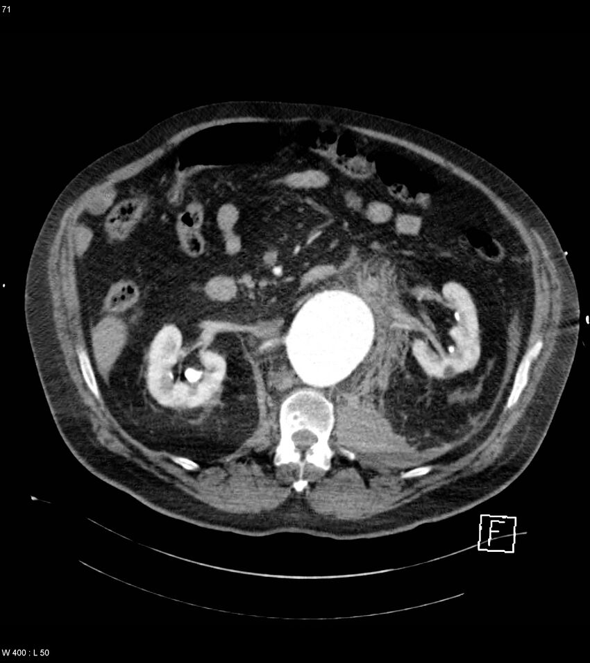 Abdominal aortic aneurysm with intramural hematoma then rupture (Radiopaedia 50278-55632 Axial C+ arterial phase 70).jpg