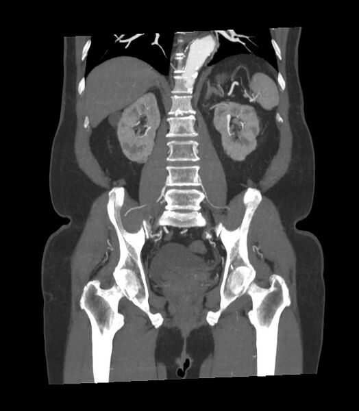 File:Abdominal aortic aneurysm with thrombus fissuration (Radiopaedia 46218-50618 Coronal C+ arterial phase 12).jpg