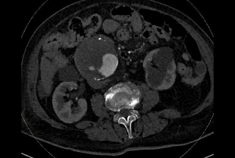 File:Abdominal aortic aneurysm with thrombus fissuration (Radiopaedia 73192-83919 Axial C+ arterial phase 100).jpg