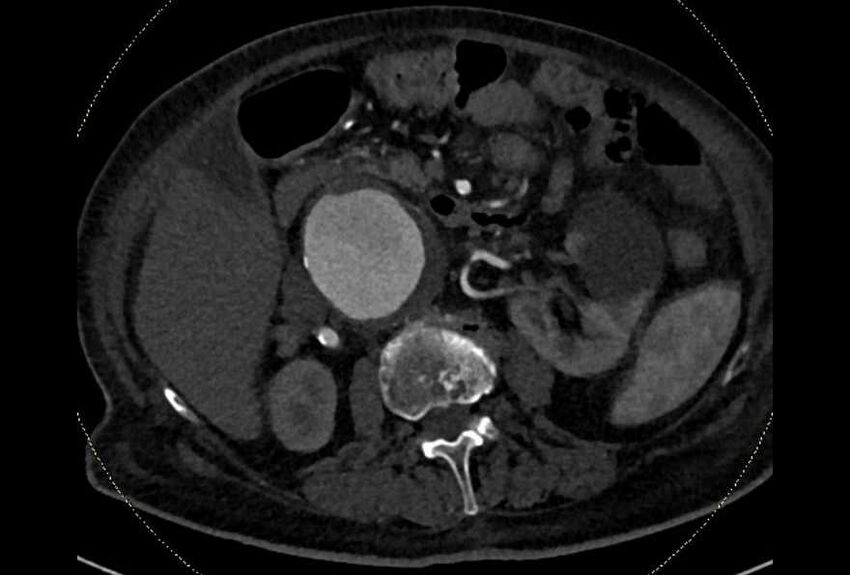 Abdominal aortic aneurysm with thrombus fissuration (Radiopaedia 73192-83919 Axial C+ arterial phase 65).jpg