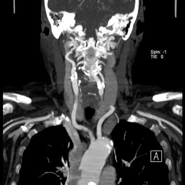 File:Aberrant right subclavian artery (Radiopaedia 22395-22430 Coronal C+ arterial phase 5).jpg