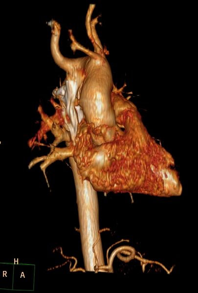 File:Aberrant right subclavian artery (Radiopaedia 67135-76475 B 17).jpg