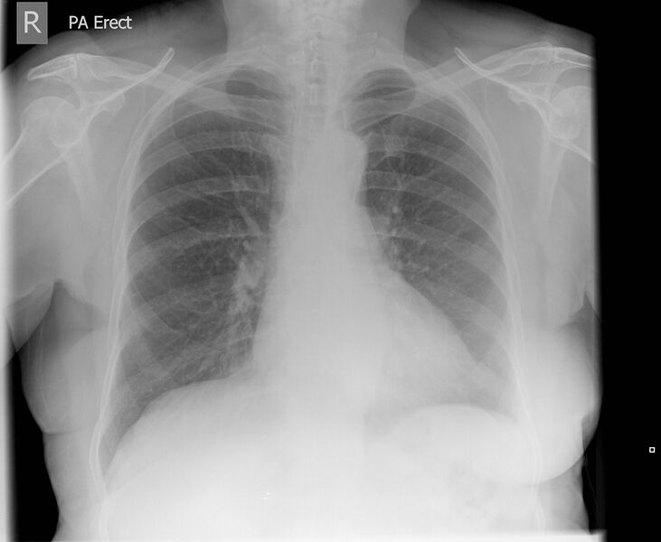 File:Absent breast shadow (mastectomy) on chest x-ray (Radiopaedia 6851).jpg