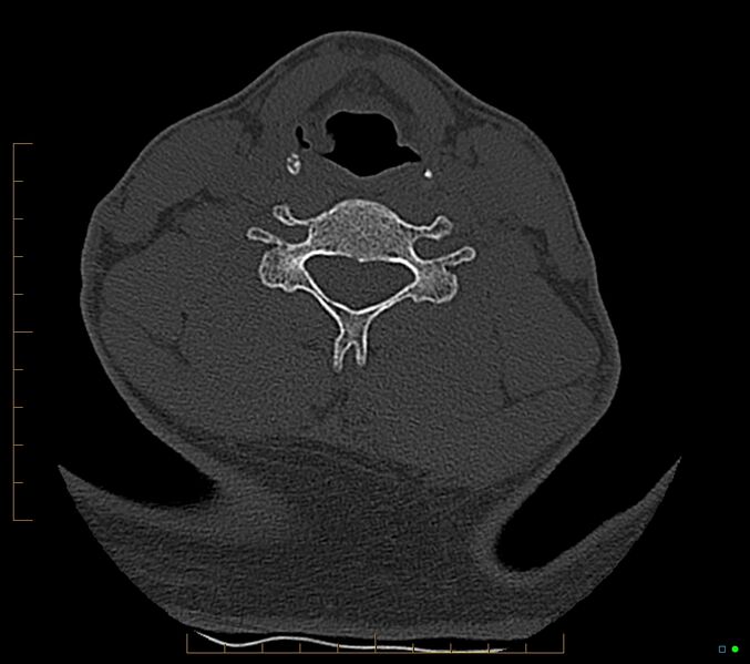File:Accessory articulation of cervical transverse processes (Radiopaedia 82715-96933 Axial non-contrast 85).jpg