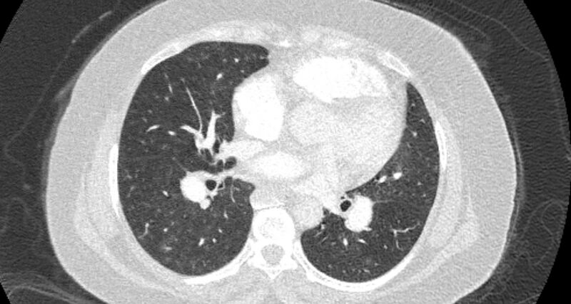 File:Accessory right inferior hepatic vein (Radiopaedia 65245-74259 Axial lung window 41).jpg