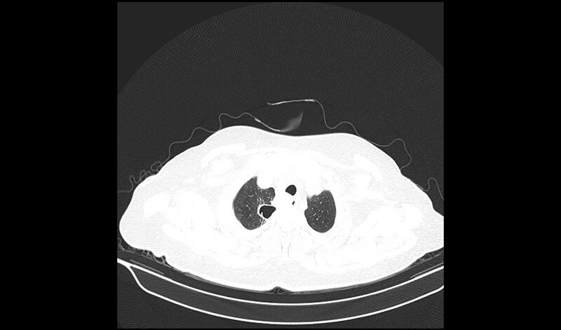 File:Acquired tracheo-esophageal fistula (Radiopaedia 51356-57103 Axial lung window 5).jpg