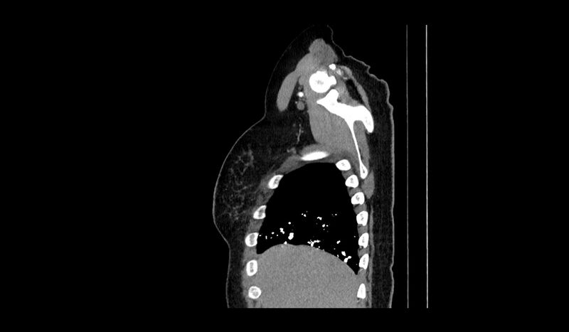 File:Acquired tracheo-esophageal fistula (Radiopaedia 51356-57103 Sagittal C+ arterial phase 17).jpg