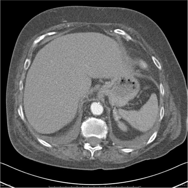 File:Acute-on-chronic pulmonary emboli (Radiopaedia 27925-28169 C+ CTPA 76).jpg