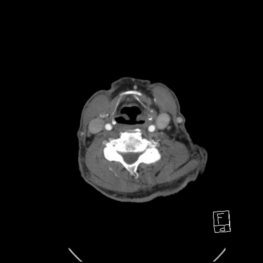 Acute ICA ischemic penumbra due to high-grade CCA stenosis (CT perfusion) (Radiopaedia 72038-82530 Axial C+ arterial phase 51).jpg