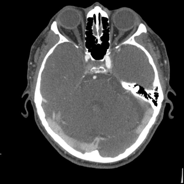 File:Acute P1 occlusion with PCA ischemia penumbra (CT perfusion) (Radiopaedia 72084-82587 Axial C+ arterial thins 67).jpg