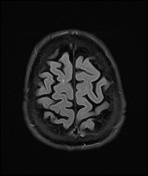 File:Acute P1 occlusion with PCA ischemia penumbra (CT perfusion) (Radiopaedia 72084-82590 Axial FLAIR 33).jpg