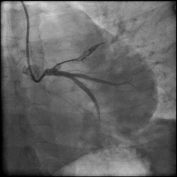File:Acute anteroseptal myocardial infarction (Radiopaedia 68409-77946 LAO caudal (spider view) LAD and CX 16).jpg