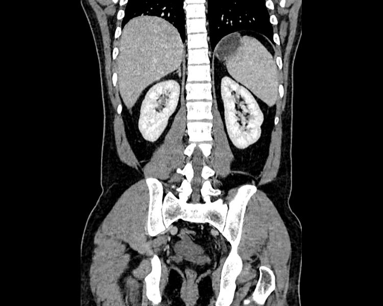 File:Acute cholecystitis (Radiopaedia 53216-59182 Coronal C+ portal venous phase 14).jpg