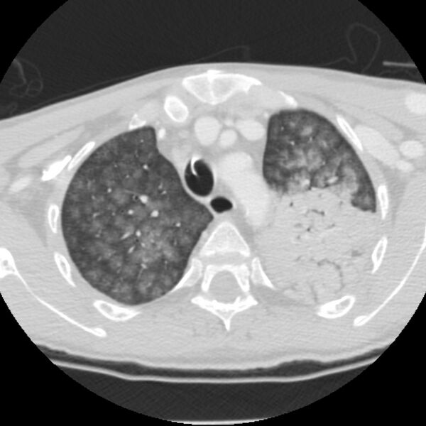 File:Acute diffuse alveolar hemorrhage (Radiopaedia 41323-44158 Axial lung window 11).jpg