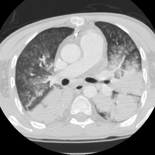 File:Acute diffuse alveolar hemorrhage (Radiopaedia 41323-44158 Axial lung window 25).jpg