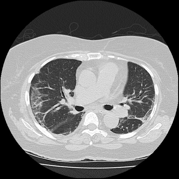 File:Acute interstitial pneumonitis (Radiopaedia 45404-49452 Axial lung window 44).jpg