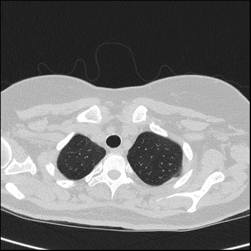 Acute interstitial pneumonitis (Radiopaedia 45404-49453 Axial lung window 12).jpg