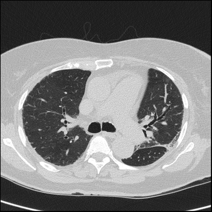 Acute interstitial pneumonitis (Radiopaedia 45404-49453 Axial lung window 35).jpg