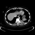 Acute myocardial infarction in CT (Radiopaedia 39947-42415 Axial C+ portal venous phase 16).jpg
