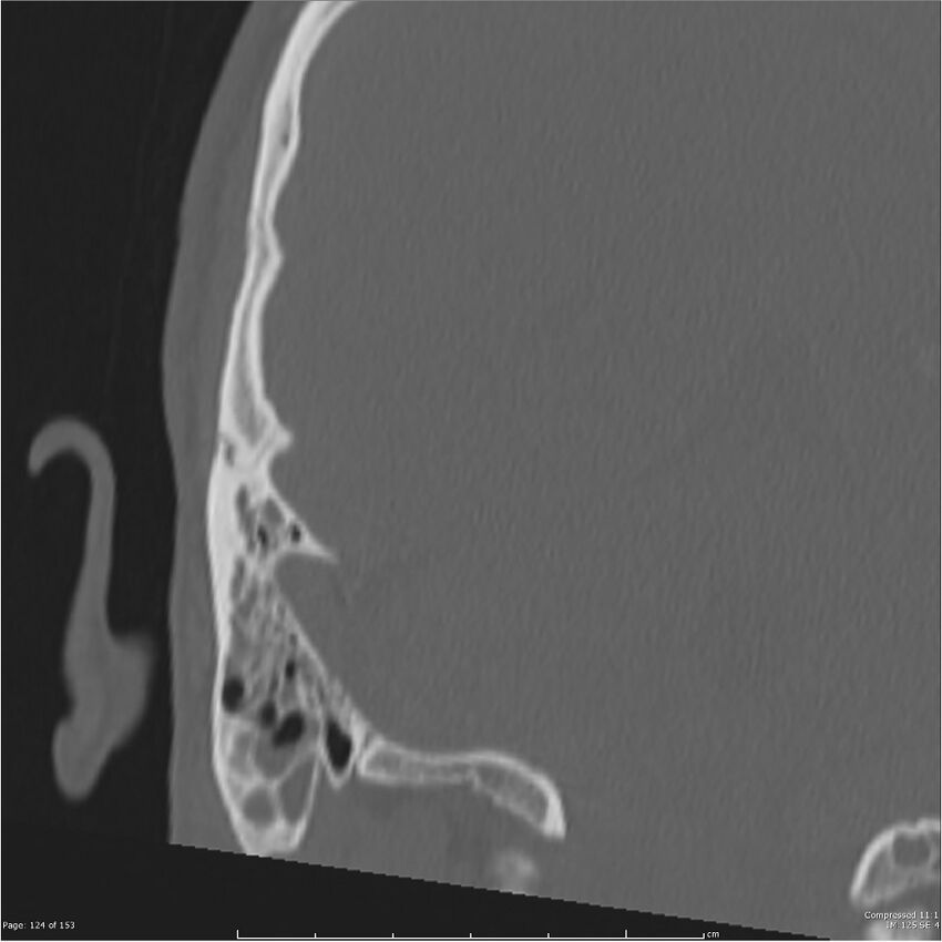 Acute otomastoiditis (Radiopaedia 28276-28512 Coronal PTB bone window reformat 55).jpg