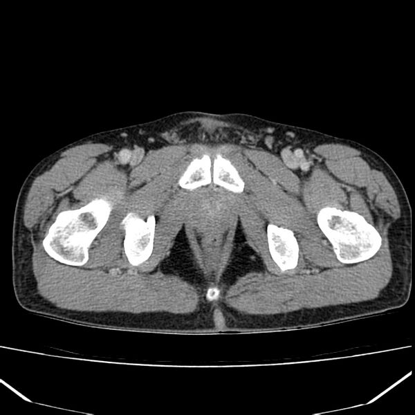 File:Acute pancreatitis (Radiopaedia 22572-22596 Axial C+ portal venous phase 75).jpg