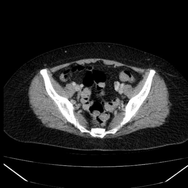 File:Acute pancreatitis - Balthazar C (Radiopaedia 26569-26714 Axial C+ portal venous phase 80).jpg