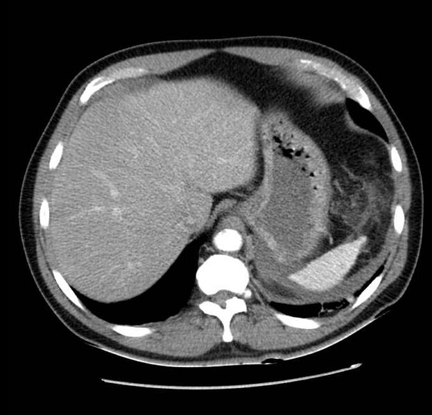 File:Acute pancreatitis - Balthazar E (Radiopaedia 23080-23110 Axial C+ arterial phase 12).jpg