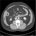 Acute pancreatitis - mild (Radiopaedia 27796-28033 C+ portal venous phase 29).jpg
