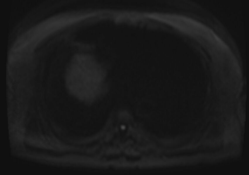 Acute portal vein thrombosis (Radiopaedia 73198-83925 Axial DWI 65).jpg