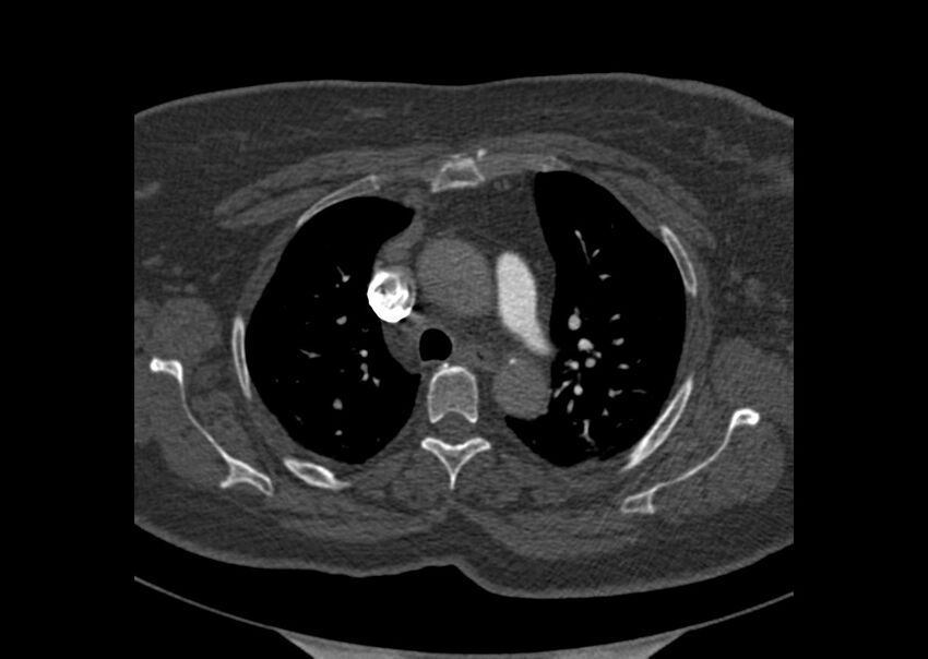Acute pulmonary embolism (Radiopaedia 29938-30466 Axial C+ CTPA 12).jpg