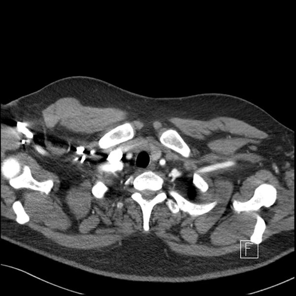 File:Acute pulmonary embolism with pulmonary infarct (Radiopaedia 73062-83768 Axial C+ CTPA 1).jpg